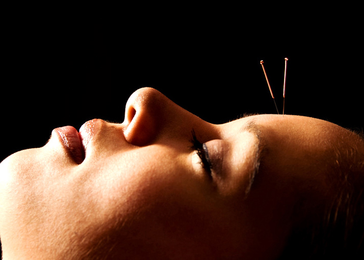 Acupuntura